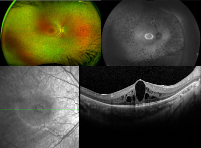 Several retinal images